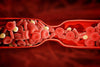 Blood Clots: 6 Things You Need to Know