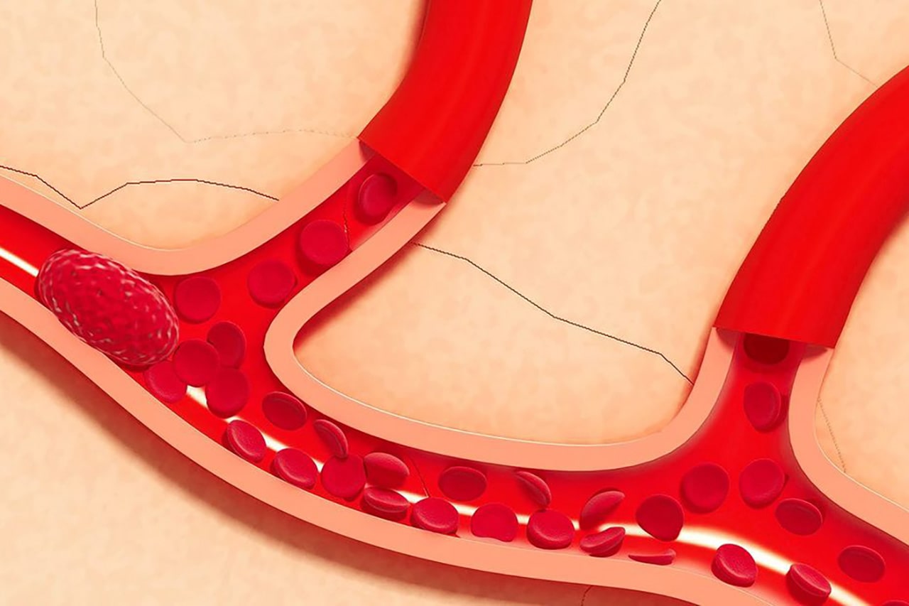 What Causes Blood Clots?